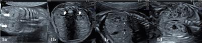 Prenatal Diagnosis and Findings in Ureteropelvic Junction Type Hydronephrosis